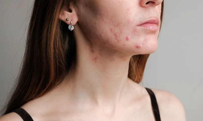 Acne Além da Adolescência: Tratamento Estético Para Adultos