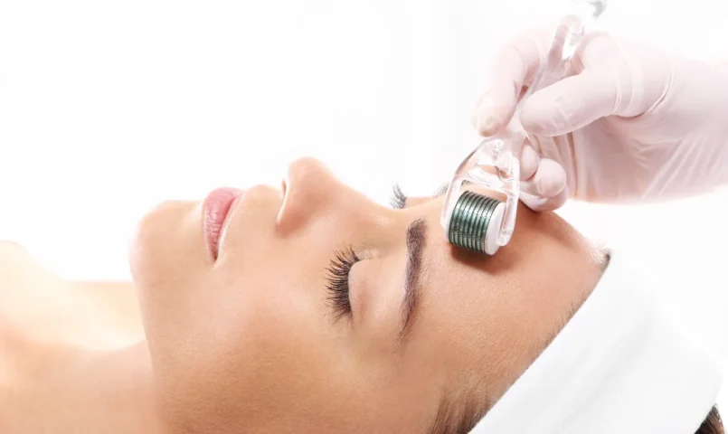Microagulhamento Facial: Como funciona, Resultados e Recomendações