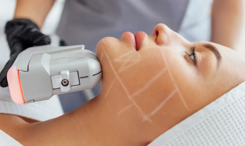 HIFU e Ultrassom Microfocado para Lifting Facial Sem Cirurgia
