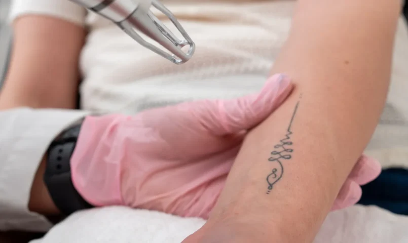 Laser para Remoção de Tatuagens: Resultados, Sessões Necessárias e Cuidados Essenciais