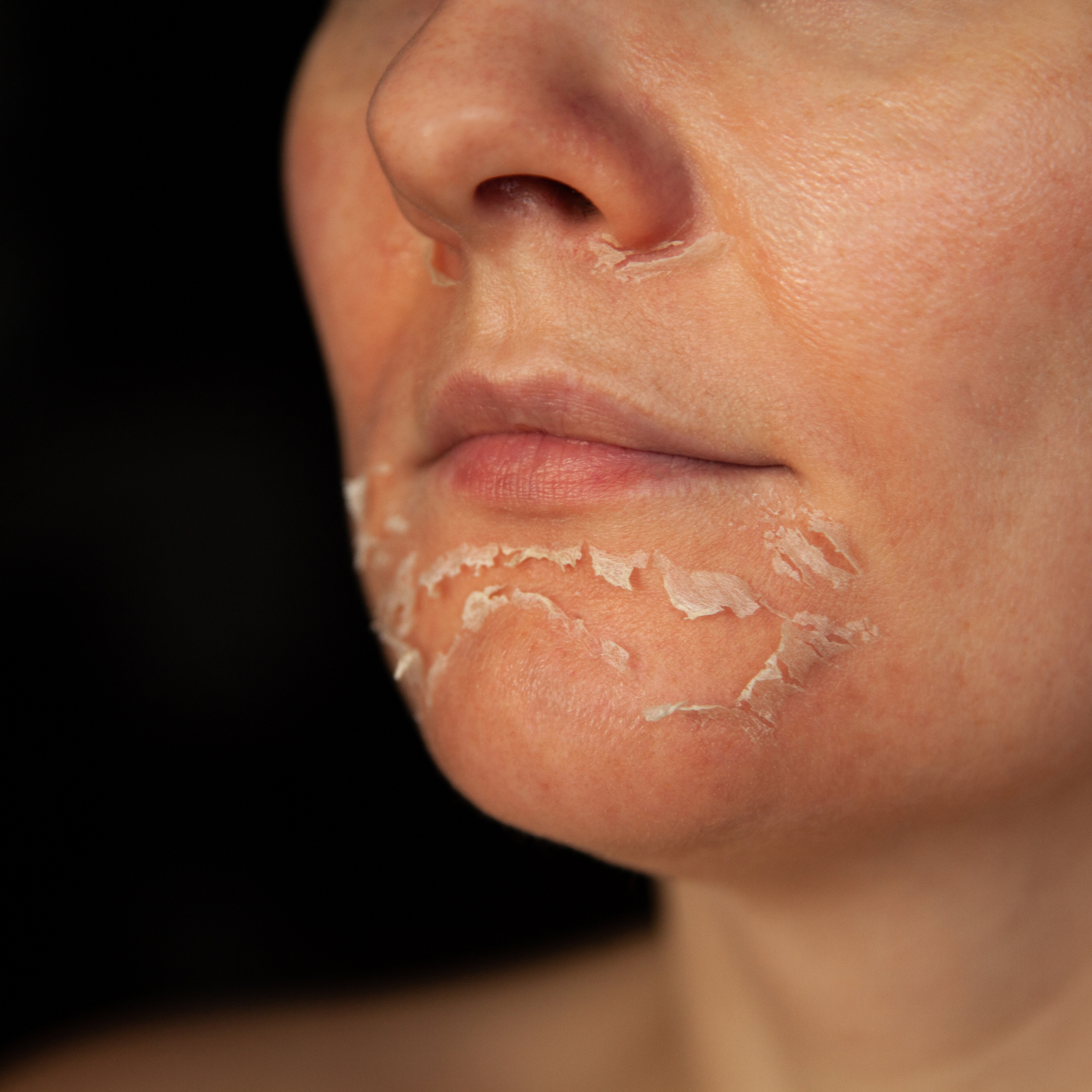 Aplicação clínica de peeling enzimático e químico com preparo de pele