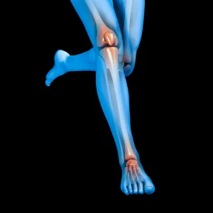 Sinais clínicos da fratura por estresse tibial em atletas